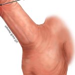 Tight or Short Frenulum of the Penis Treatment