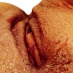 Vulvitis