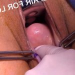 Video Gallery Labia Mons Pubis Procedures